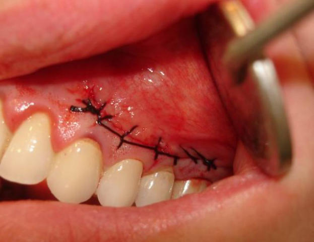 зуб после удаления кисты