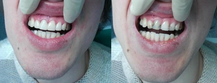 реставрация зубов до-после