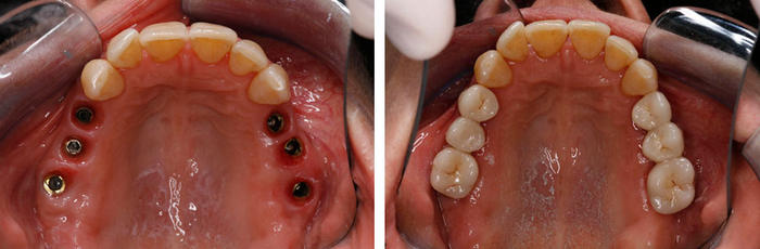 имплантация нескольких зубов