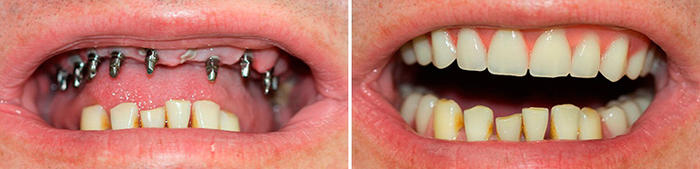 импланты на зубы