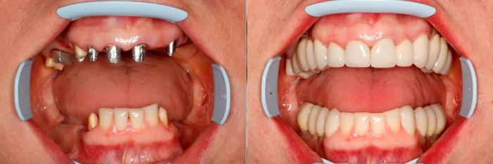 имплантация зубов на верхней челюсти