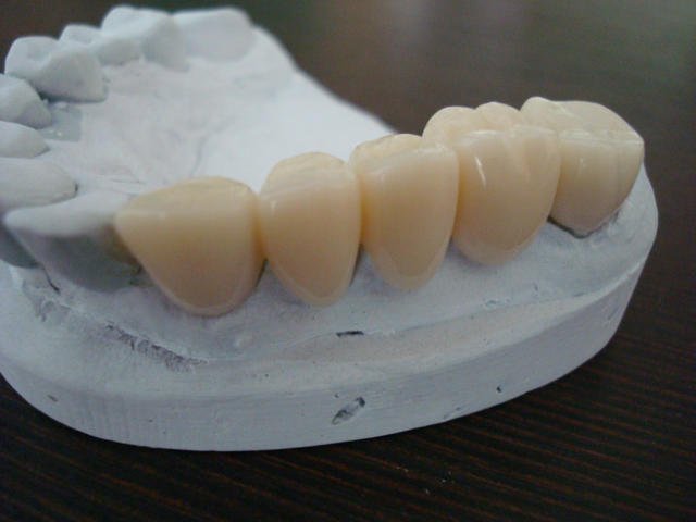 коронки на зубы из пластмассы