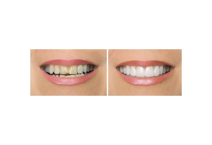 микропротезирование зубов до и после