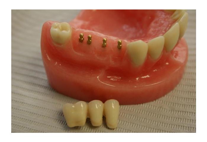имплантология зубов в москве