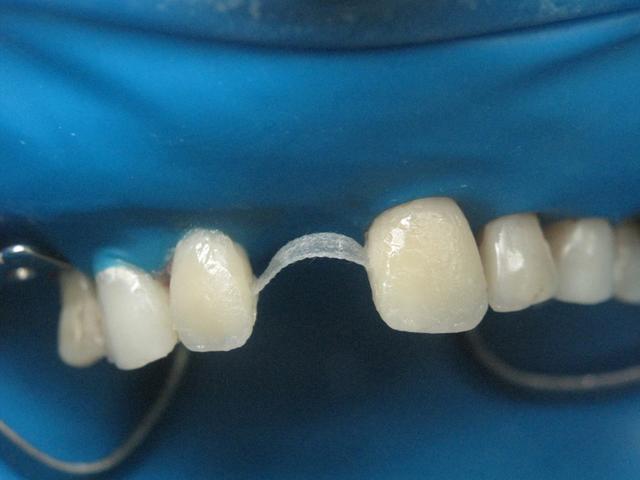 протезы на зубы москва