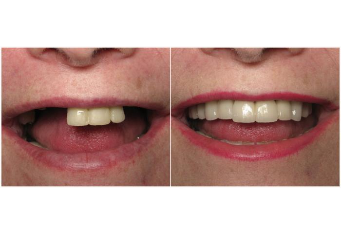 протезирование зубов до после