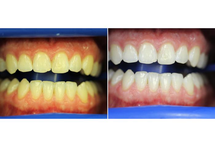Klox отбеливание зубов отзывы biorepair fast sensitive repair зубная паста для чувствительных зубов 75 мл