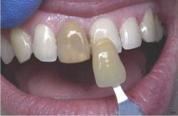 Основные причины почему чернеют зубы и как лечить потемневшие зубы